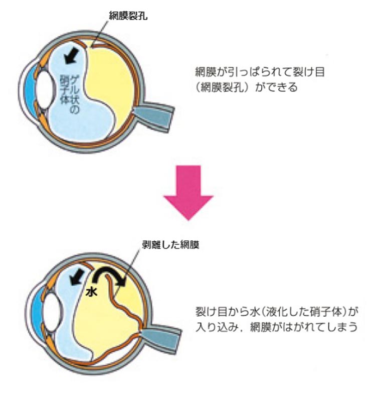 網膜が引っぱられて裂け目（網膜裂孔）ができる → 裂け目から水（液化した硝子体）が入り込み、網膜がはがれてしまう