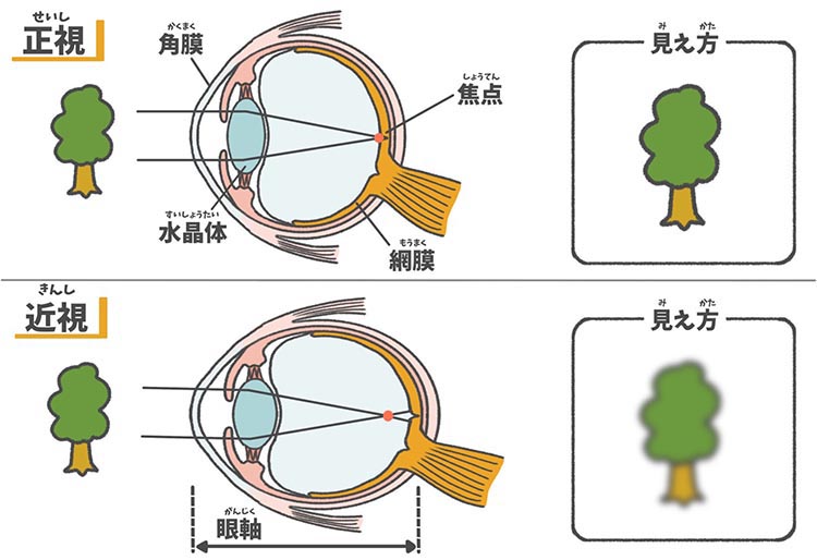 正視と近視の見え方の違いと眼球の断面図